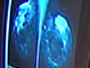 Digital vs. film mammograms