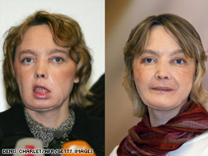 Isabelle Dinoire underwent the first partial face transplant; shortly after her surgery (left) and 10 months later (right).