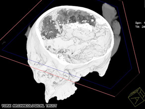 A representation of the skull generated from the CT scans taken at York Hospital.