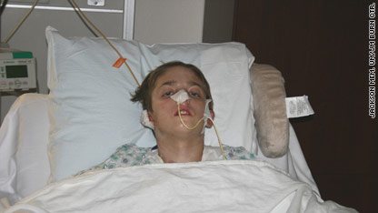 Burned teen's mom: 'It hurts my heart'