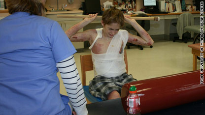 Teen who was set on fire leaves hospital