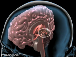 In deep brain stimulation, electrodes deliver impulses to the substantia nigra, which coordinates movement.