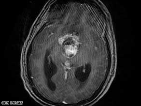 MRI scan pre-operation: The boy's extremely large tumor was located right in the center of the brain.
