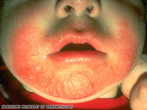 eczema by mouth