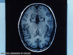 Raptiva may cause a serious brain infection called progressive multifocal leukoencephalopathy.