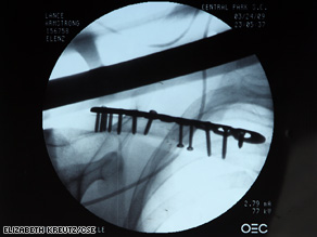 Cyclist Lance Armstrong needed 12 screws to repair his broken collarbone.