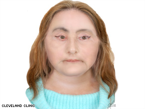 Culp spoke at a news conference Tuesday where she was identified as the first U.S. recipient of a face transplant.