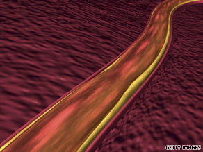 cholesterol artery