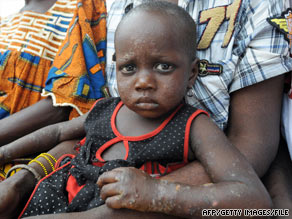 Parents say their child's body is covered in lesions as a result of toxic waste dumped in Ivory Coast in 2006.
