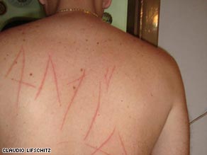 Claudio Lifschitz shows off the scars he says kidnappers carved on his back.
