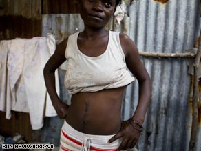 Roudeline Lamy shows the scar from her bullet wound. At 26, she's a widow after losing her husband to gangland violence.