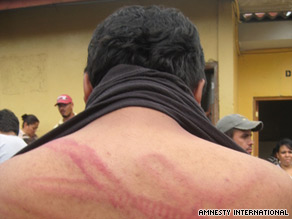 The marks of a police truncheon are shown on a student's back after a protest, Amnesty International says.