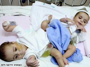 The Saudi surgical team works to separate the Egyptian twin boys.
