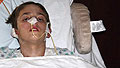 Burned teen's mom: 'I'm proud'