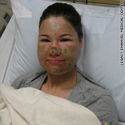 Police: Washington woman admits acid attack was hoax