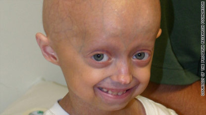 Clues in mysterious kid's aging disease