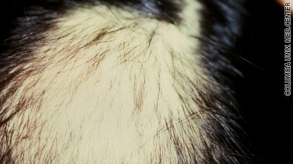 Steroid injections in scalp for hair loss