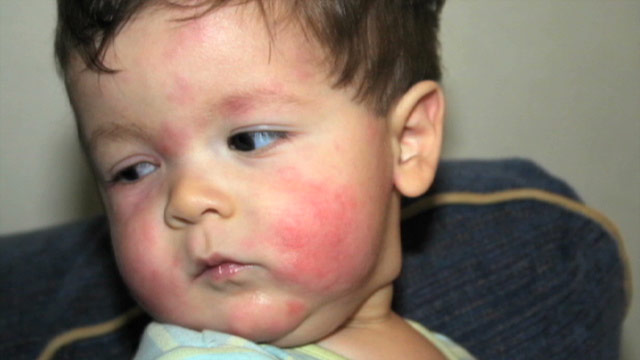 Child Allergy