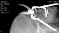 Man's eye saved after impalement