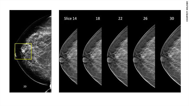 3-D mammogram system approved
