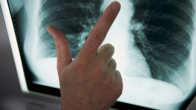 CDC reports lowest TB rates ever in U.S.