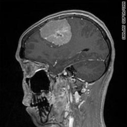 Can a fast-growing meningioma be benign?