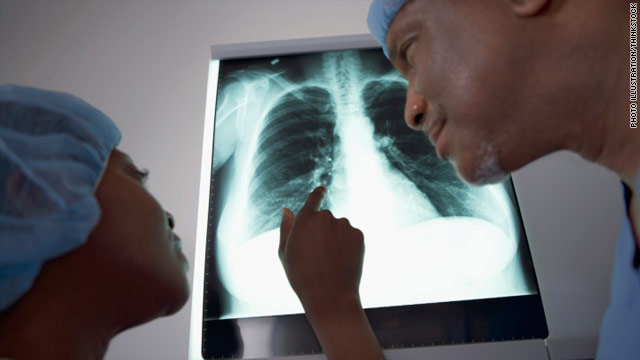 Simplifying treatment for TB without symptoms