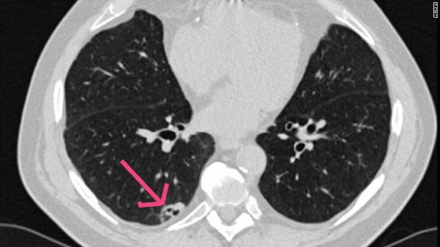CT scans show promise for lung cancer screening
