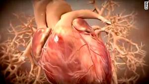 Heart attacks: What you should know