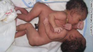 Joined at the chest and abdomen, these twins were born in a remote region of Cameroon.