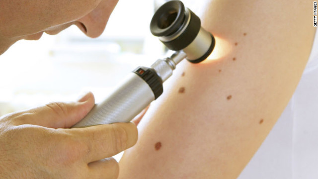 Cancer survivors have higher risk of melanoma