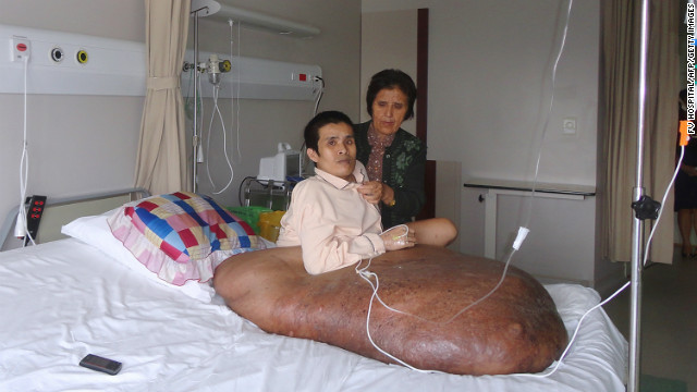 Exitosa cirugía: le extirpan un tumor de 90 kilos a un vietnamita