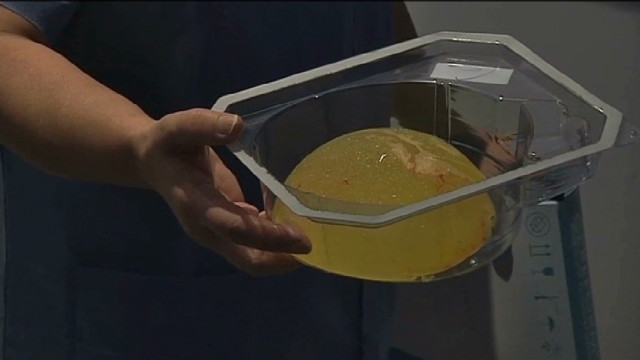 Uk Breast Implant Victims Want Answers 