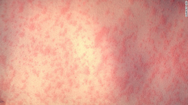 Measles cases found after Super Bowl festivities