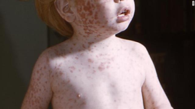 Measles cases reached 15-year high in 2011