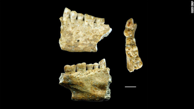 Oldest tooth filling may have been found