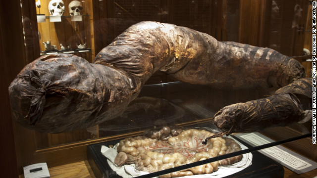 This repulsive item, a pathologically enlarged colon -- a megacolon -- is on view at the Mütter Museum of The College of Physicians of Philadelphia. Untreated Hirschsprung's disease, causing chronic constipation, resulted in this massive 8-foot-long organ. A wax model of a normal-sized colon is displayed below. Ewww.