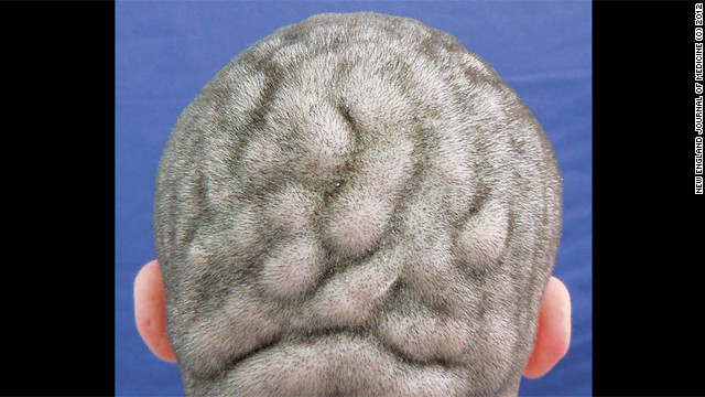 Una rara condición provoca que el cuero cabelludo se vea como un cerebro
