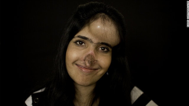 Aesha Mohammadzai is transforming both physically and emotionally. Six months into multistage reconstructive surgery, she's on her way to having the nose she's wanted since she was disfigured and left for dead in Afghanistan.