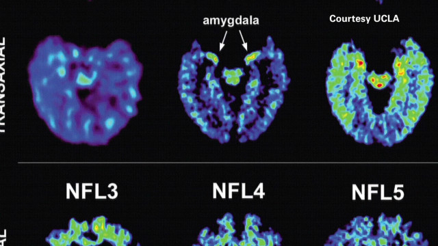 Un examen permite detectar daños cerebrales en jugadores de la NFL