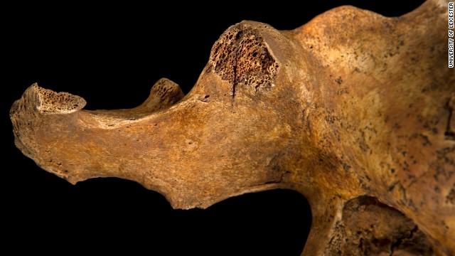 The image shows a blade wound to the pelvis, which has penetrated all the way through the bone.