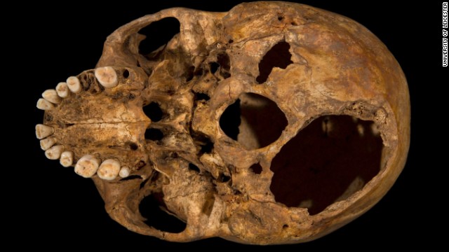 The base of the skull shows the larger of two potentially fatal injuries. This shows clearly how a section of the skull had been sliced off.
