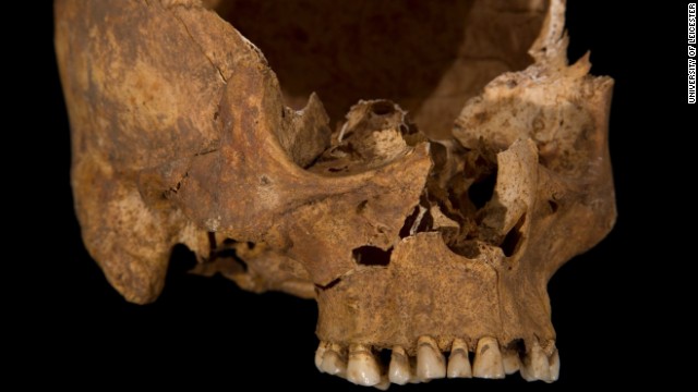 A wound to the cheek, possibly caused by a square-bladed dagger. The front part of the skull has separated naturally along the line of a suture (a joint between the skull bones), which is why it is not present in this picture. This would have fused as Richard became older had he lived.