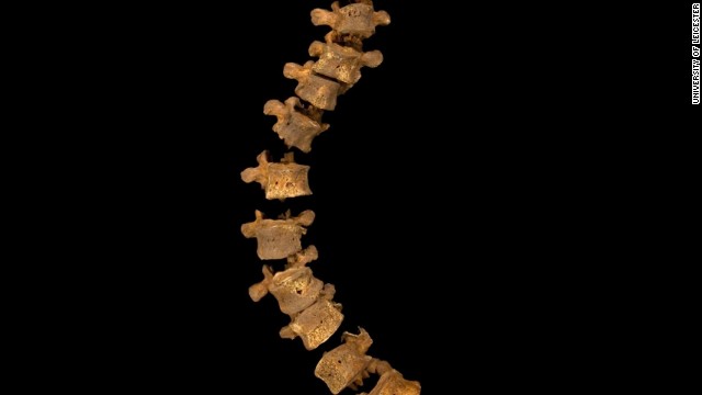 As the skeleton was being excavated, a notable curve in the spine could be seen. (The width of the curve is correct, but the gaps between vertebrae have been increased to prevent damage from them touching one another.)