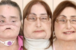 Pacientes de transplantes de cara