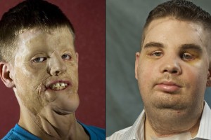 Pacientes de transplantes de cara