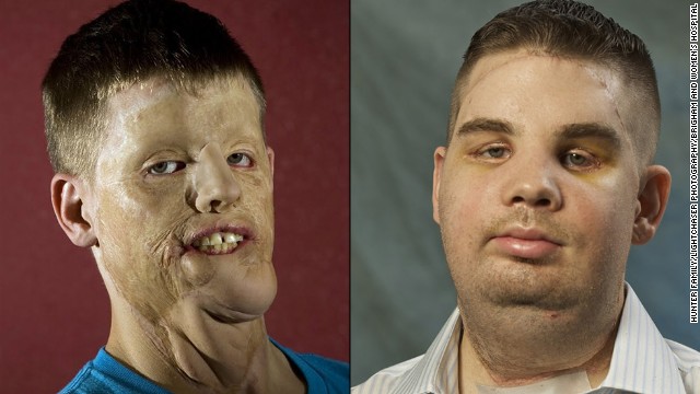 Mitch Hunter suffered significant injury after a car accident in 2001. After a face transplant, he now has near-normal sensation, and his speech has continued to improve.