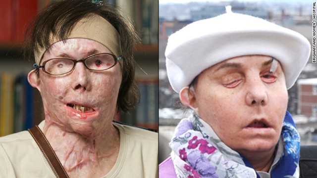 Carmen Blandin Tarleton became disfigured after her estranged husband doused her with industrial-strength lye. After a face transplant, she says she's "thrilled" and has a new goal: to kiss her boyfriend.