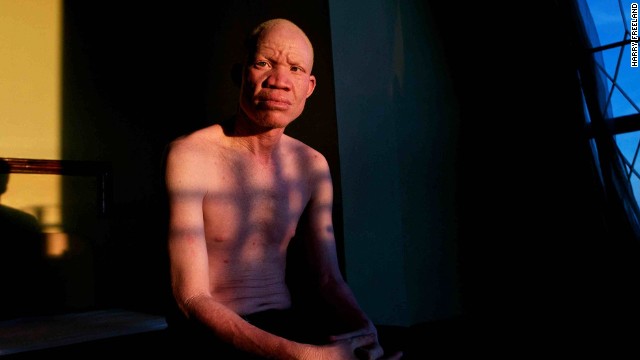 Josephat Torner is an albino activist from Tanzania. His fight for equality and acceptance of people with his condition has been captured in a new documentary called "In the Shadow of the Sun."