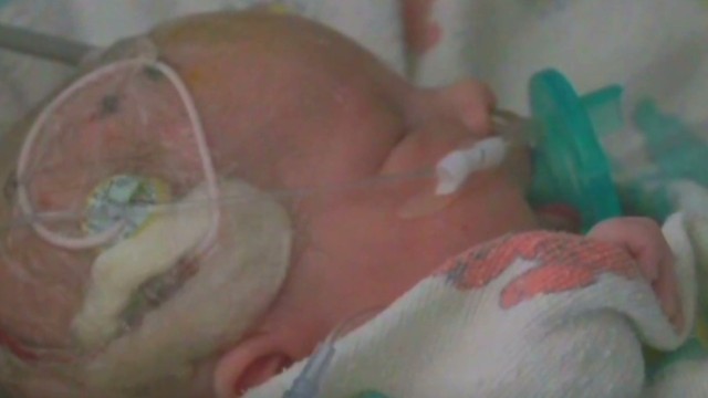 Un superpegamento cierra el aneurisma de una bebé y le salva la vida